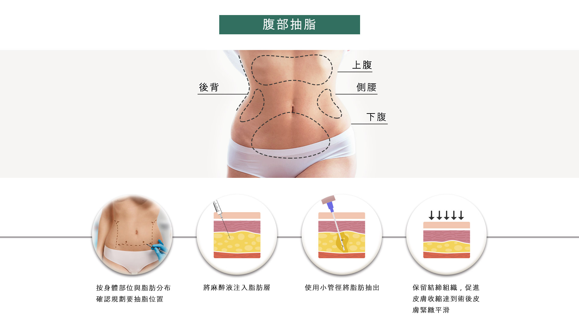 桃園抽脂手術_永恆醫美