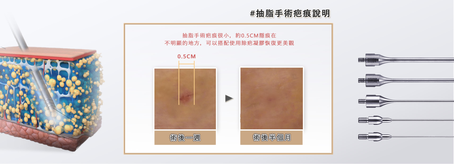 桃園抽脂手術_永恆醫美