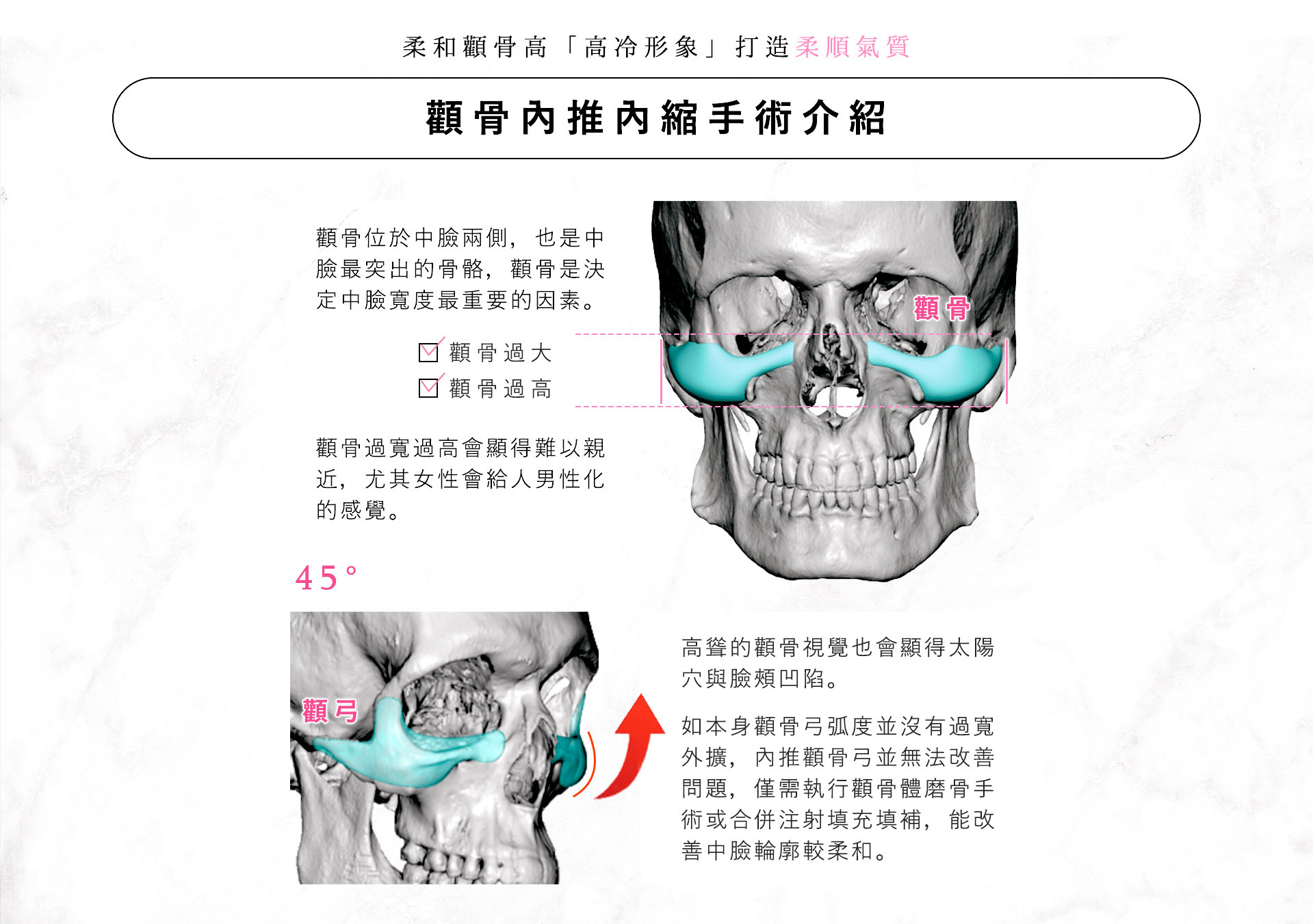 台南桃園削骨手術,台南桃園顴骨內推,台南桃園下顎骨角削骨,台南桃園下巴截骨