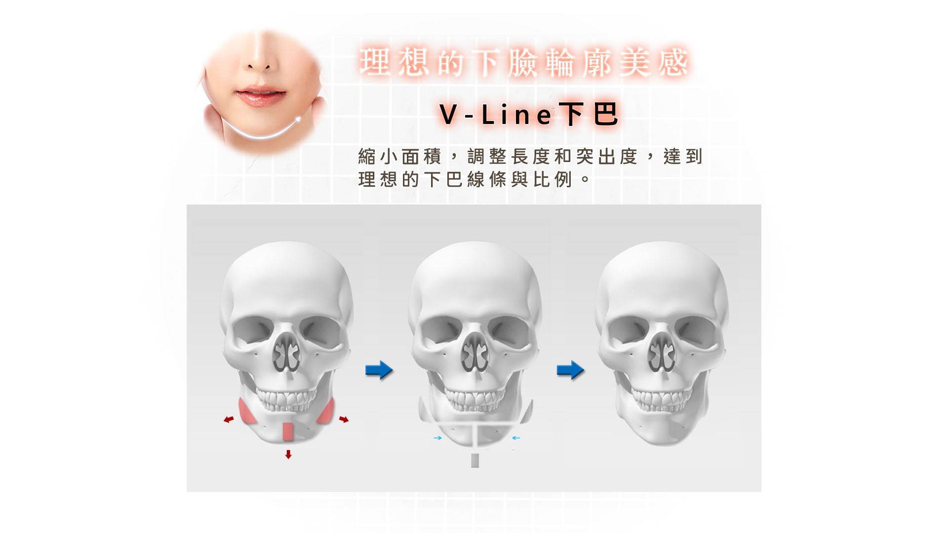 台南桃園削骨手術,台南桃園顴骨內推,台南桃園下顎骨角削骨,台南桃園下巴截骨