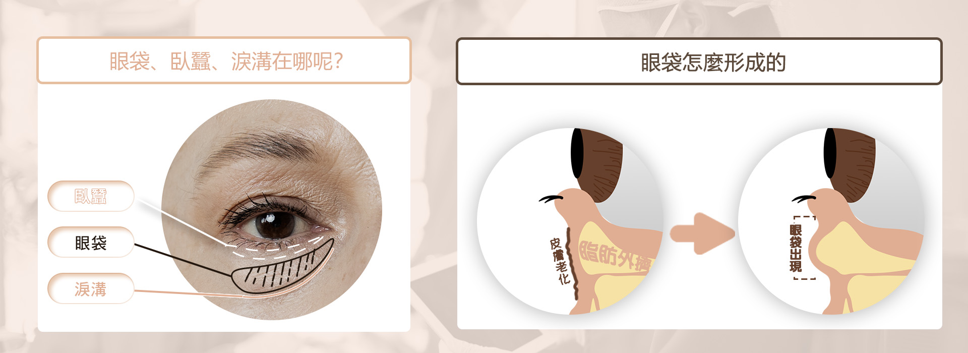 桃園眼袋手術_眼袋手術