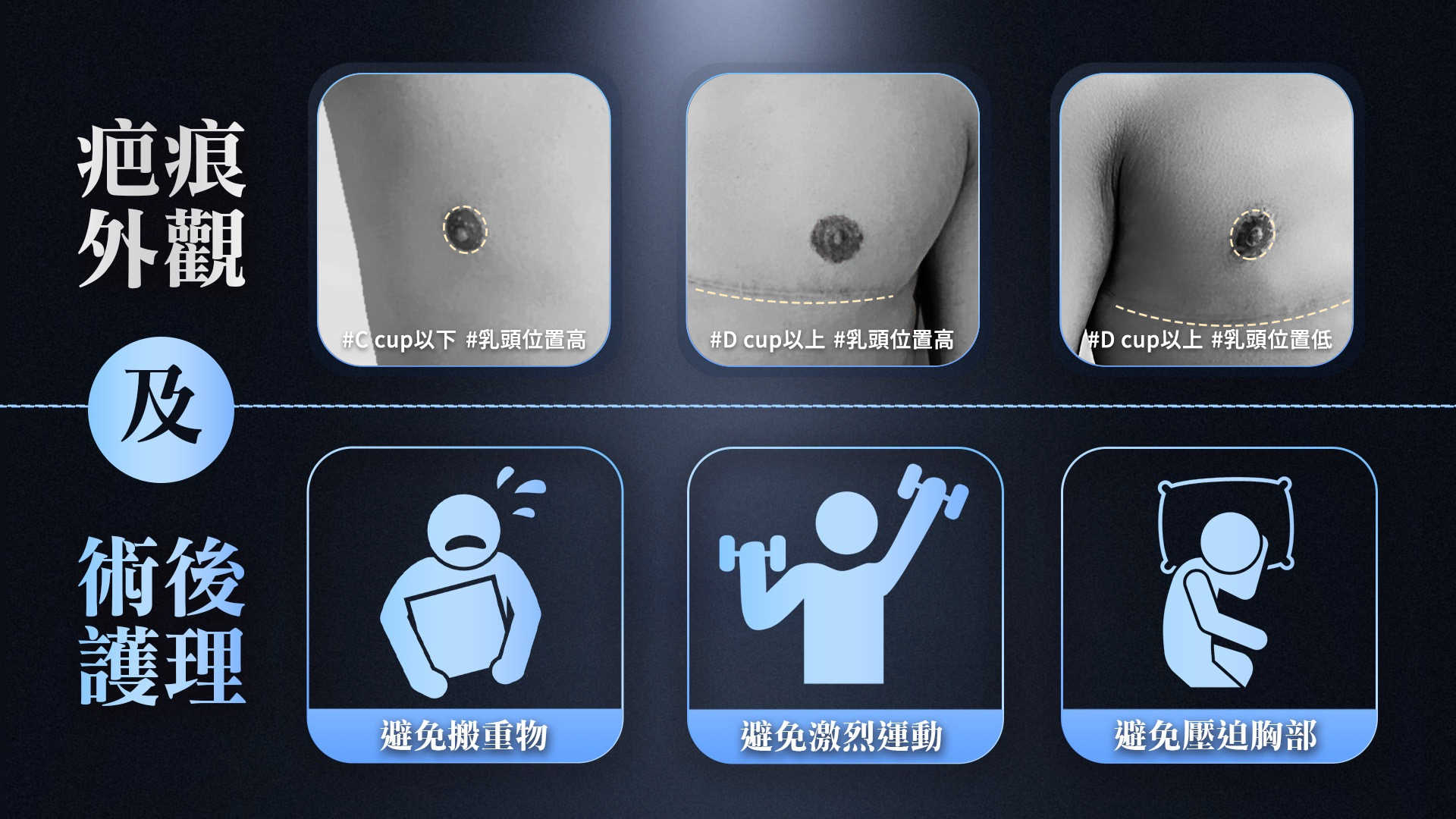 桃園平胸縮胸切乳手術權威醫師推薦007