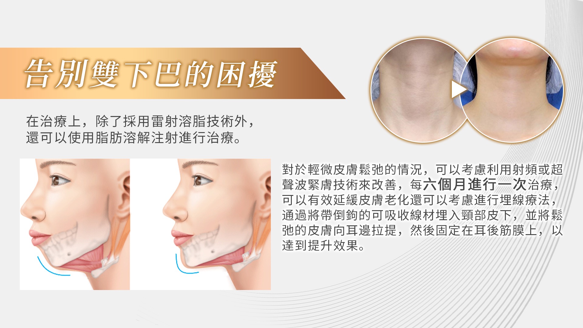 桃園天鵝頸手術權威醫師推薦005