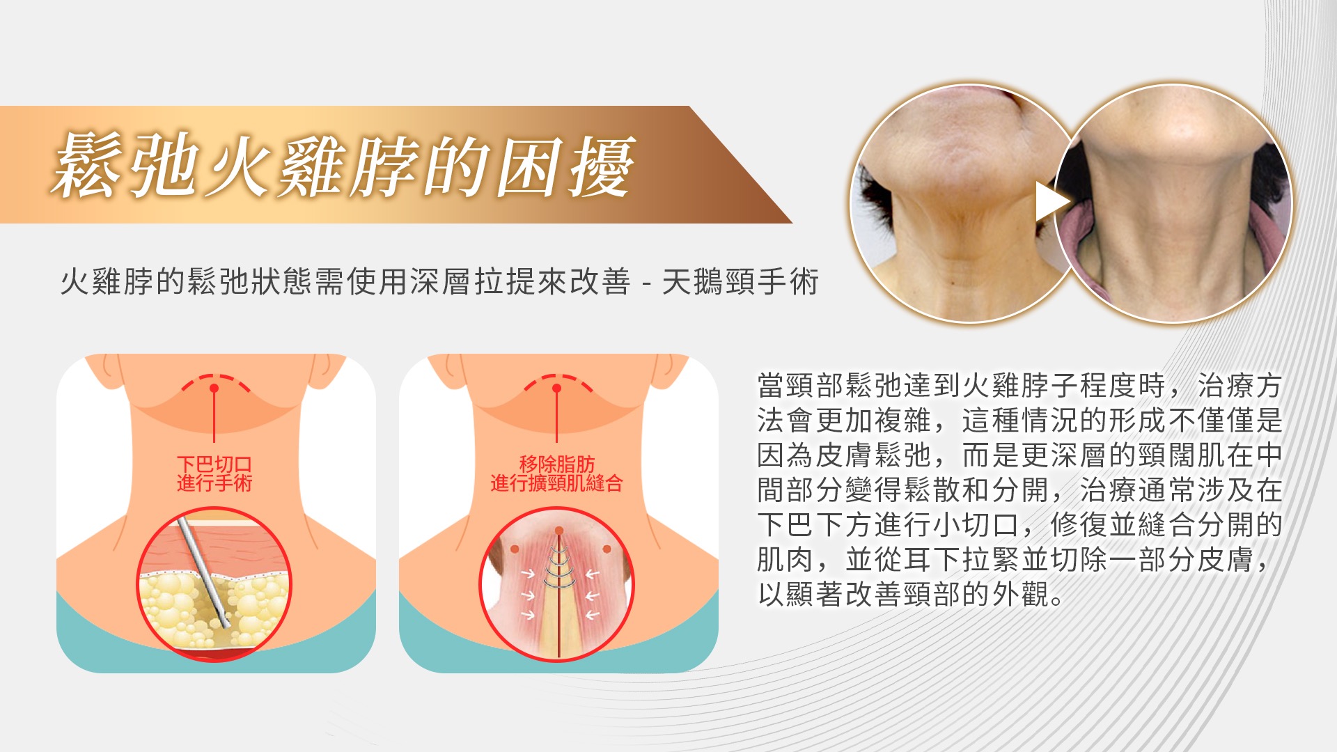 桃園天鵝頸手術權威醫師推薦006