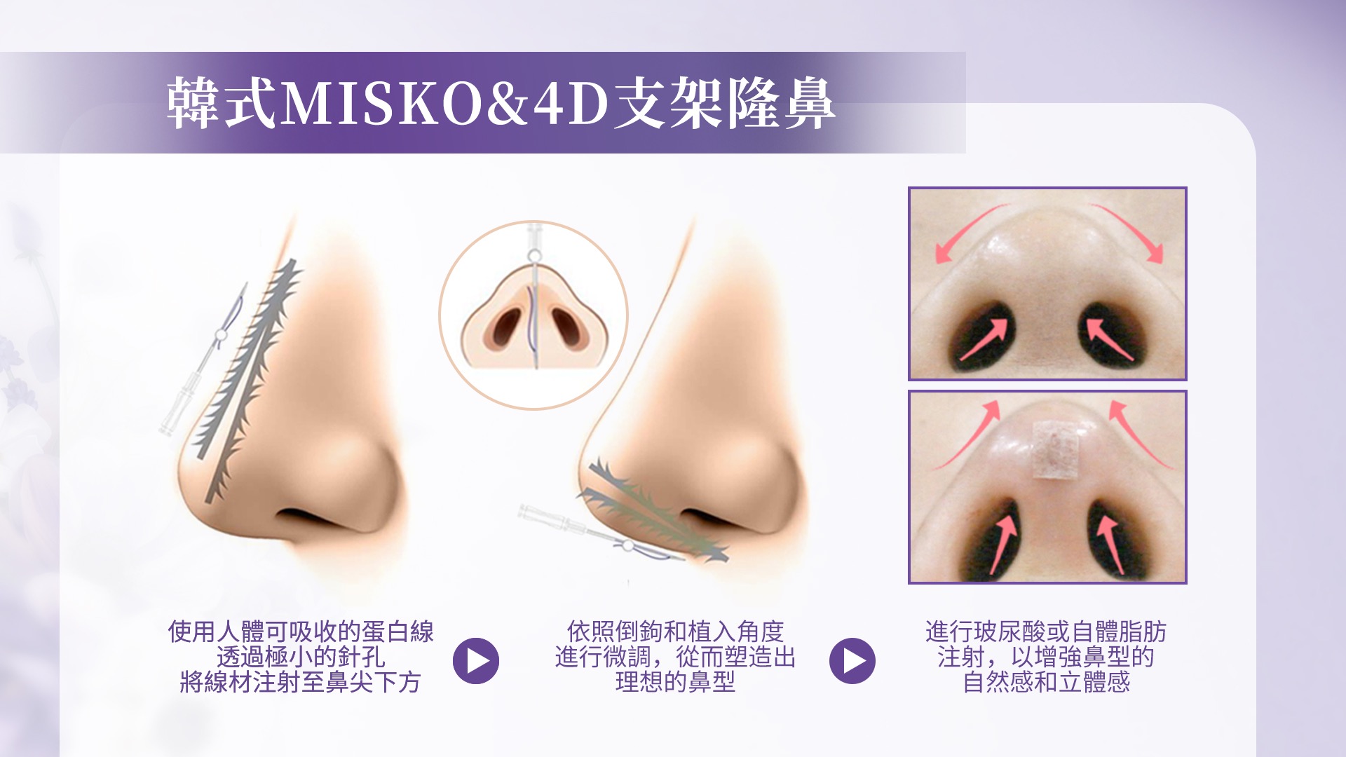 桃園埋線隆鼻權威醫師推薦價格費用006