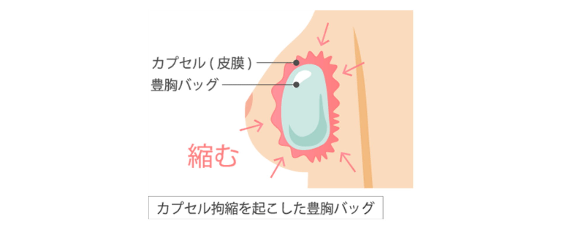 桃園隆乳失敗問題莢膜攣縮Dr.邱智弘醫師隆乳權威能重建