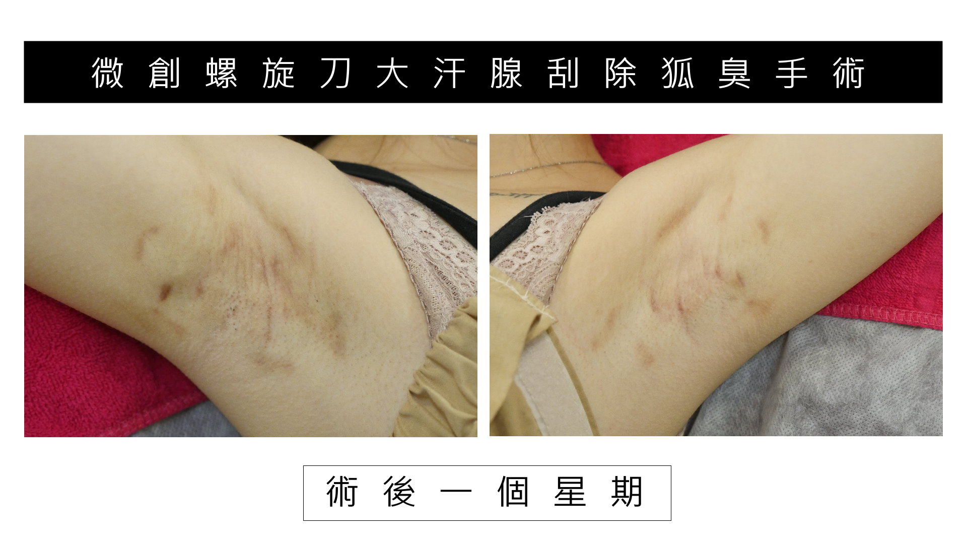 桃園除狐臭手術權威醫師價格費用01