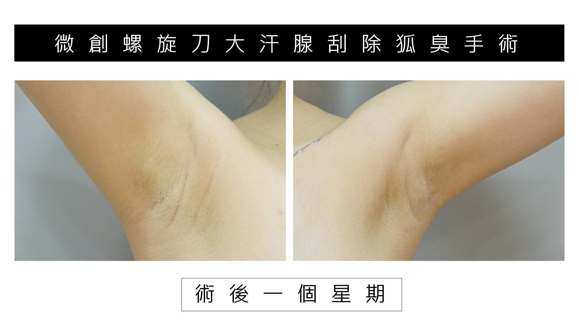 桃園除狐臭手術權威醫師價格費用02